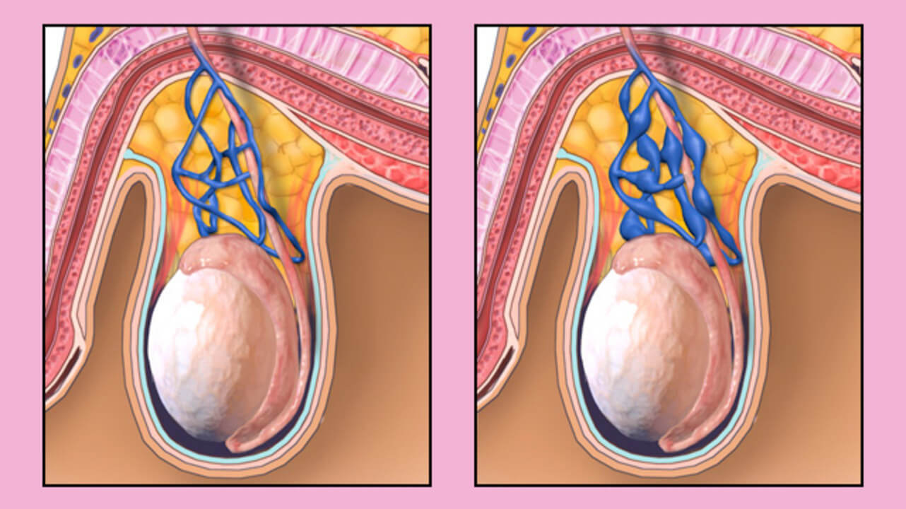 Варикоз Вен Семенного Канатика