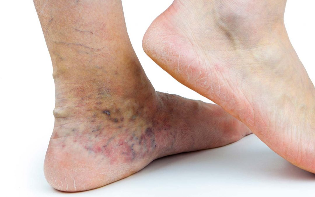 Eczema varicoasă, Eczema cu tratament pentru picioare varicoase