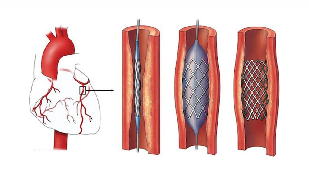 Стентирование видео. Коронарное стентирование. Стентирование коронарных артерий схема. Коронарное стентирование сосудов сердца. Коронарная ангиопластика и стентирование.